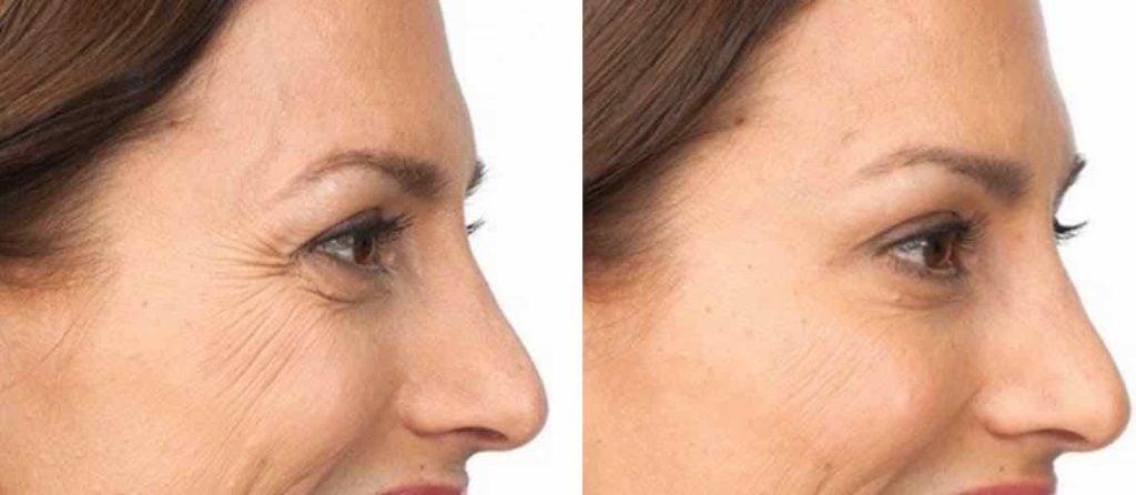 Før og etter botox filler behandling